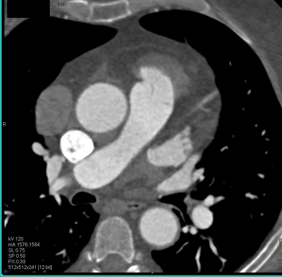 Thymoma - CTisus CT Scan