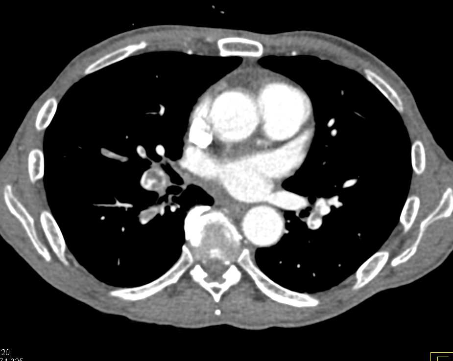 Multiple Pulmonary Embolisms (PEs) in a Patient with Pancreatic Cancer - CTisus CT Scan