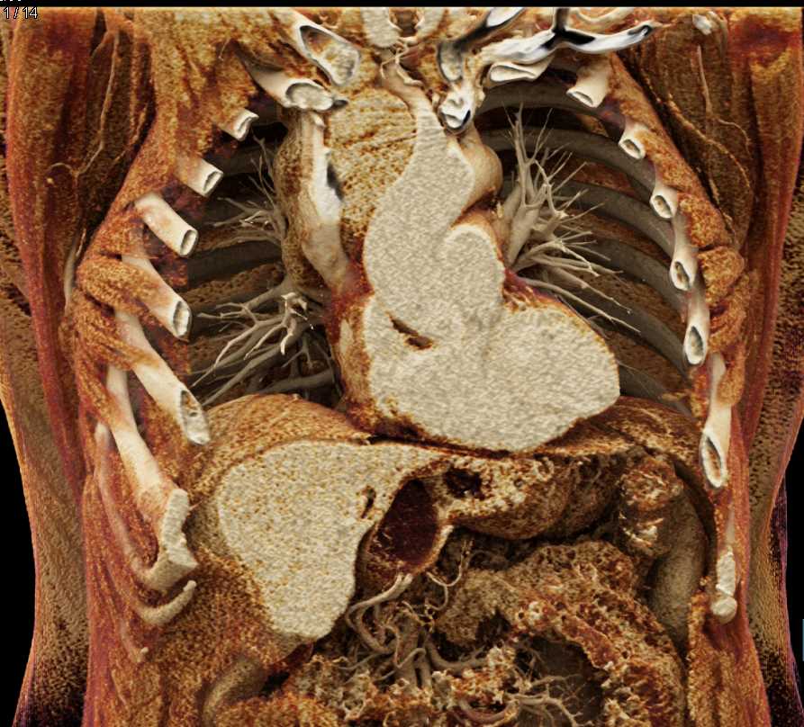 Lymphoma with Extensive Mediastinal Adenopathy - CTisus CT Scan