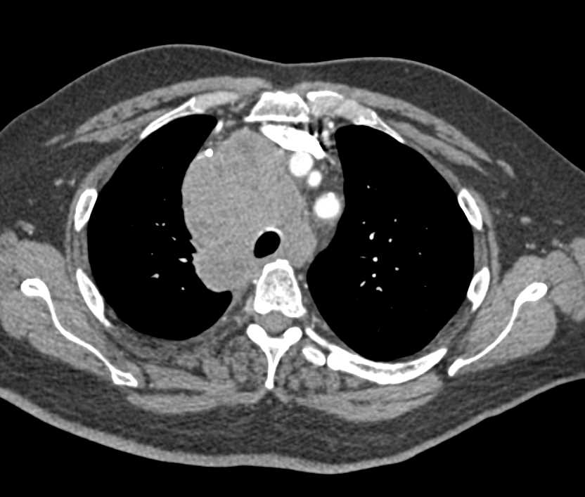 Lymphoma with Extensive Mediastinal Adenopathy - CTisus CT Scan