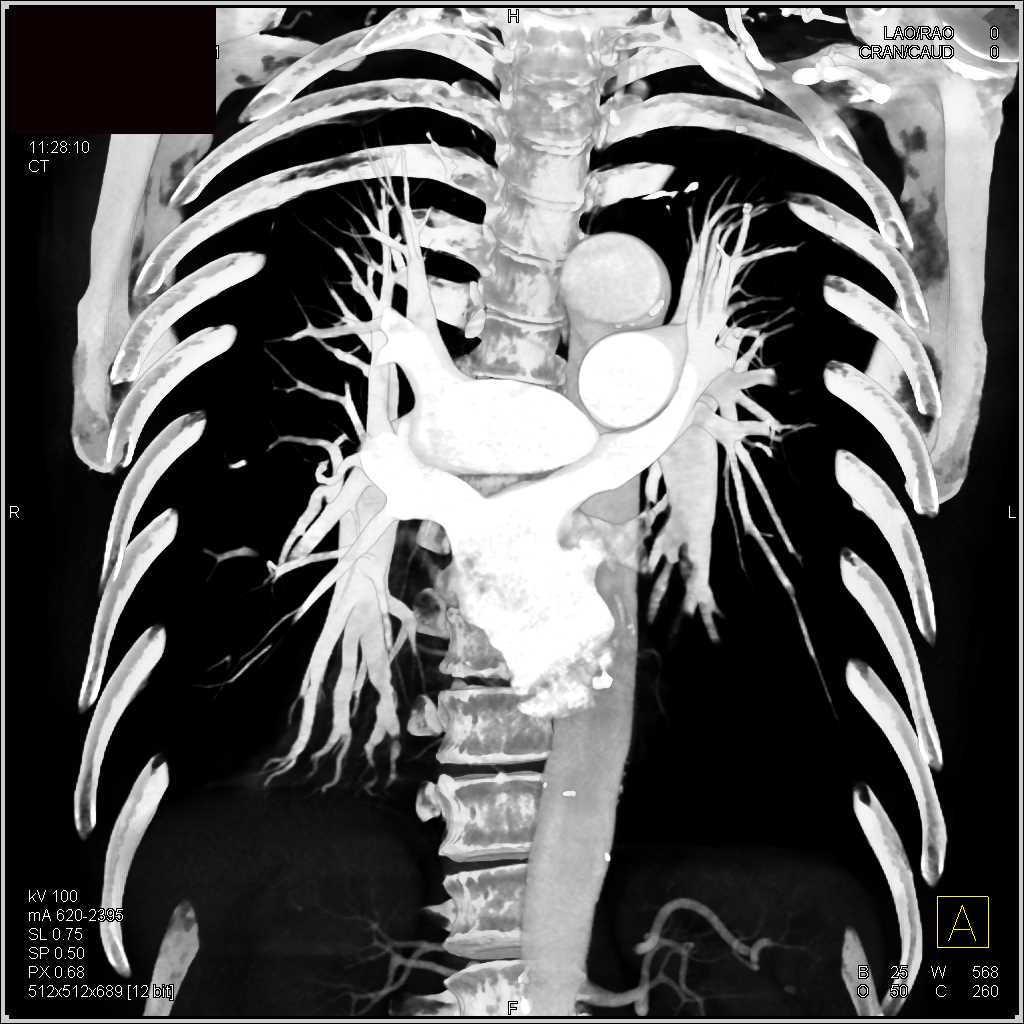 Bronchiectasis as well as Pulmonary Embolism - CTisus CT Scan