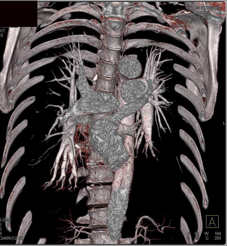 Bronchiectasis as well as Pulmonary Embolism - CTisus CT Scan
