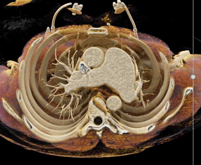 Dilated Main Pulmonary Artery with Cinematic Rendering - CTisus CT Scan