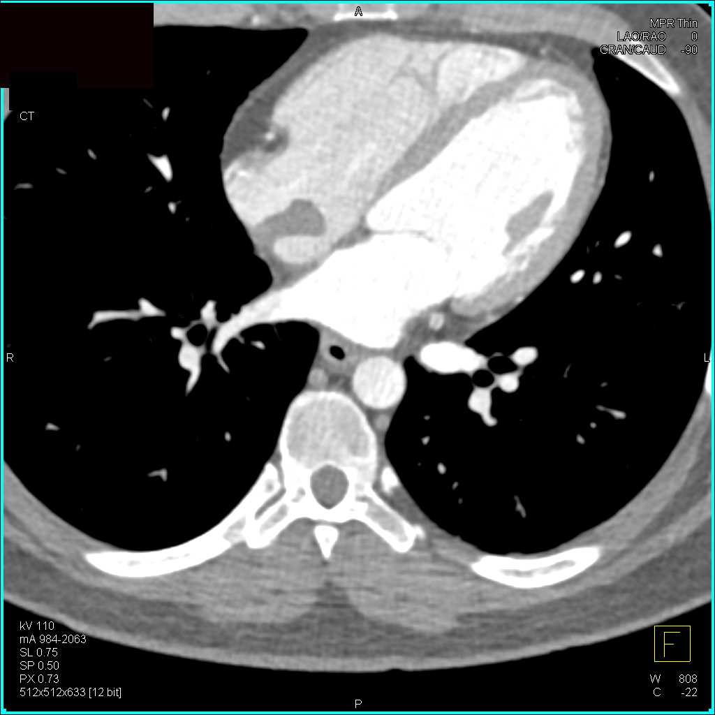 Atrial Myxoma - CTisus CT Scan