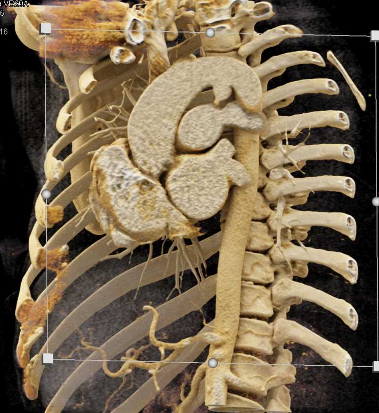 Patent Ductus Arteriosus (PDA) with Ductus Bump Seen on 3D Sagittal Projection - CTisus CT Scan