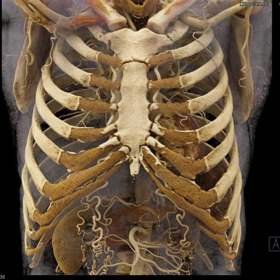 Coarctation of the Aorta with Multiple Collaterals - CTisus CT Scan