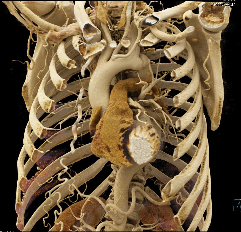 Coarctation of the Aorta with Multiple Collaterals - CTisus CT Scan