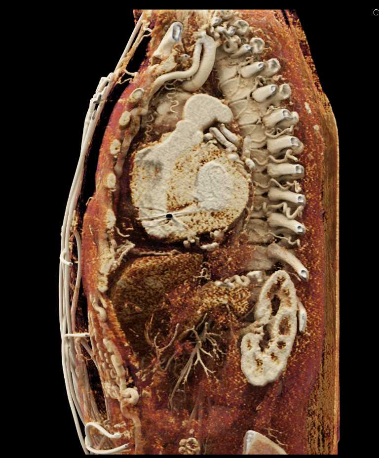 Extensive Collaterals with Dilated Internal Mammary Arteries - CTisus CT Scan