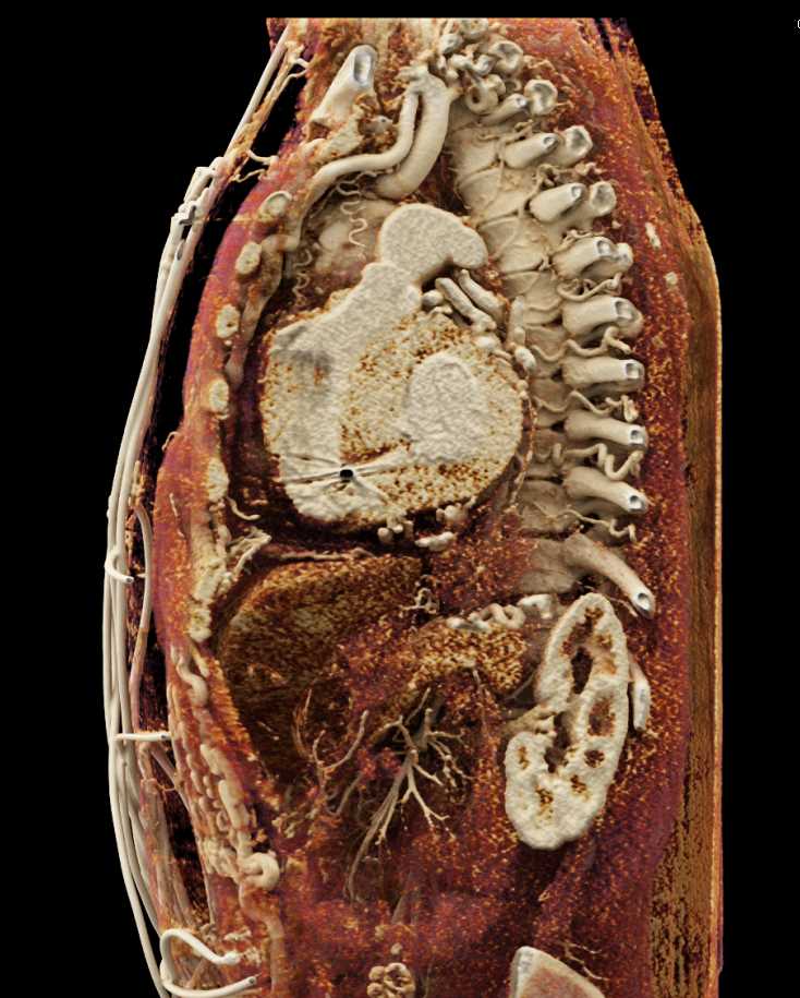 Extensive Collaterals with Dilated Internal Mammary Arteries - CTisus CT Scan