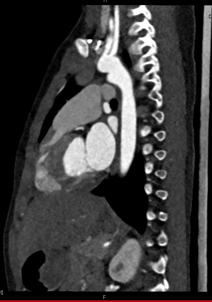 Ductus Aneurysm - CTisus CT Scan