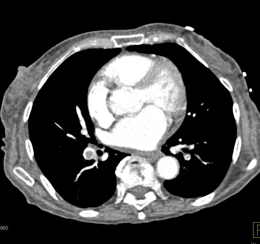 Multiple Pulmonary Emboli (PEs) in a Patient with Pancreatic Cancer - CTisus CT Scan