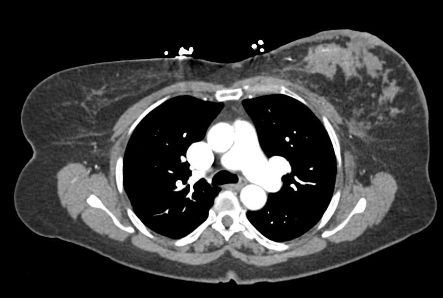 Left Breast Cancer with Axillary Adenopathy - CTisus CT Scan