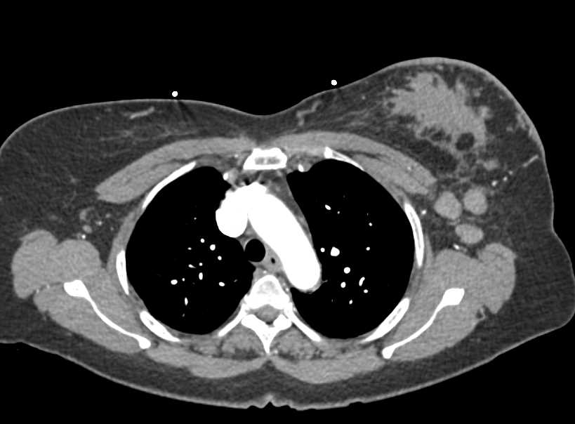 Left Breast Cancer with Axillary Adenopathy - CTisus CT Scan
