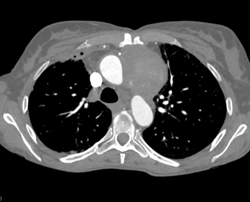 Pseudoaneurysm Aorta with Delayed Filling - CTisus CT Scan