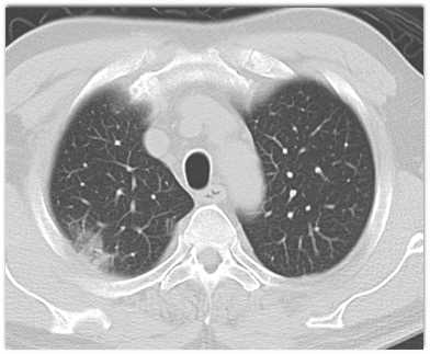 COVID-19 Pneumonia - CTisus CT Scan