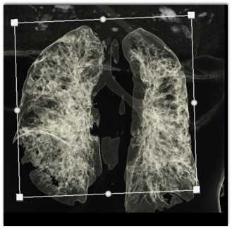 COVID-19 Pneumonia in 3D - CTisus CT Scan