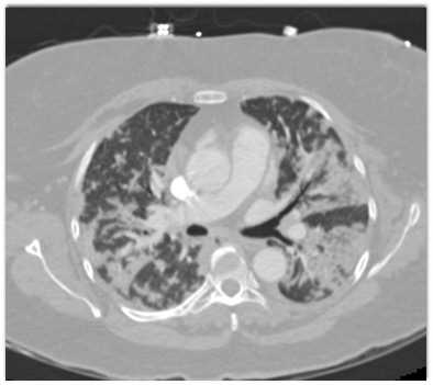 COVID-19 Pneumonia - CTisus CT Scan