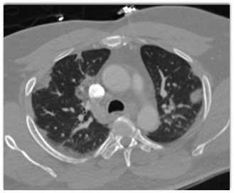 COVID-19 Pneumonia - CTisus CT Scan