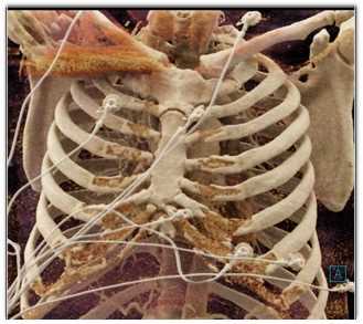 COVID-19 Pneumonia with Cinematic Rendering - CTisus CT Scan