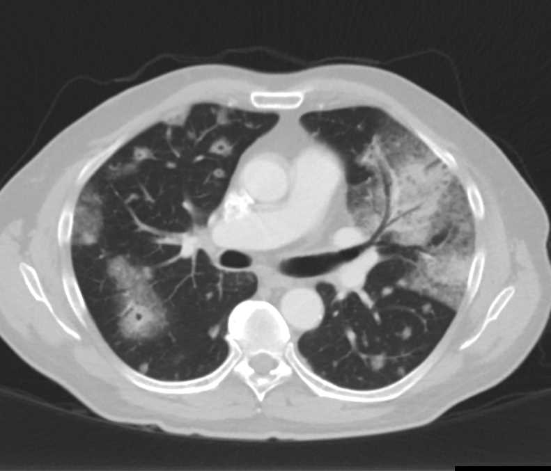 Septic Emboli - CTisus CT Scan