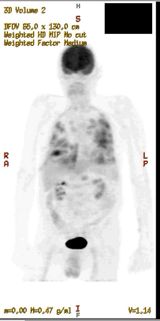 Septic Emboli on PET CT - CTisus CT Scan