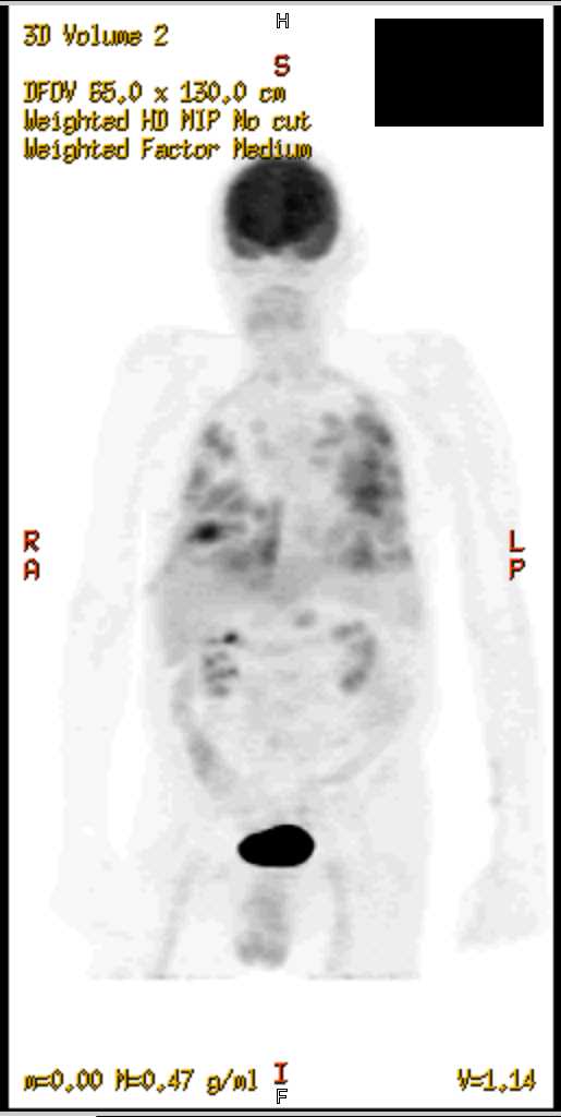 Septic Emboli on PET CT - CTisus CT Scan