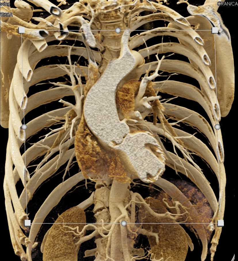 Dilated Aortic Root - CTisus CT Scan