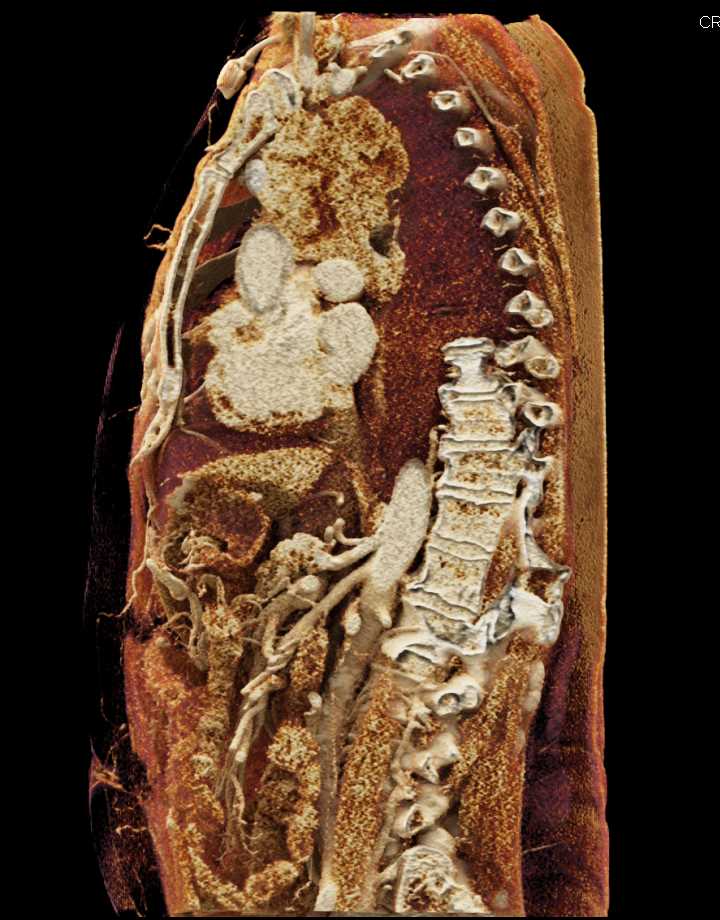 Thymoma - CTisus CT Scan