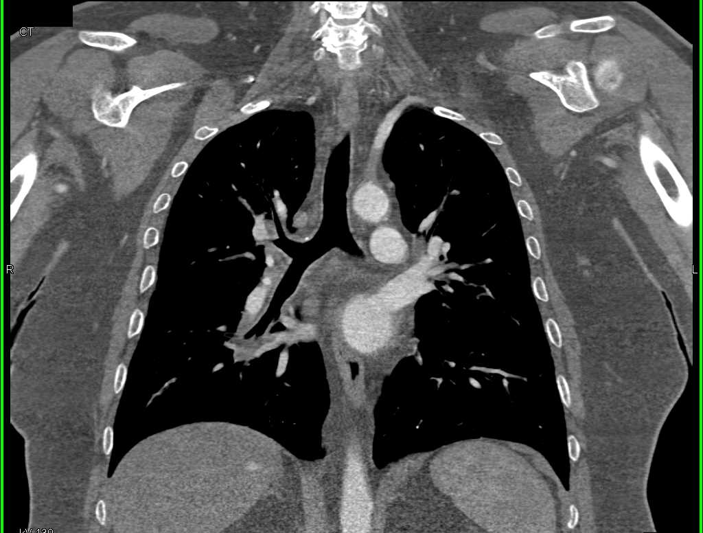 Mucoid Impaction in the Airways - CTisus CT Scan