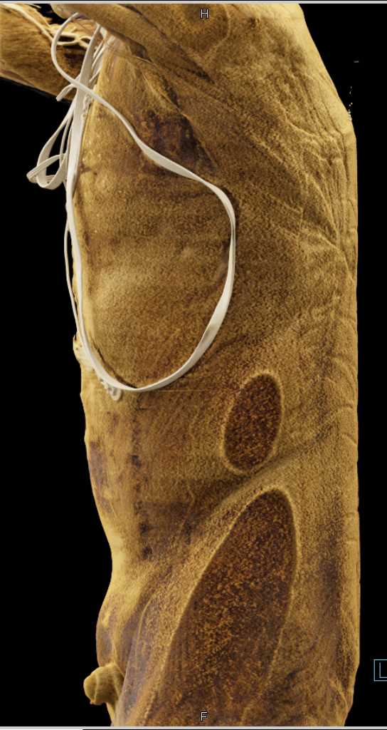 Repair of Thoracic Aortic Dissection - CTisus CT Scan