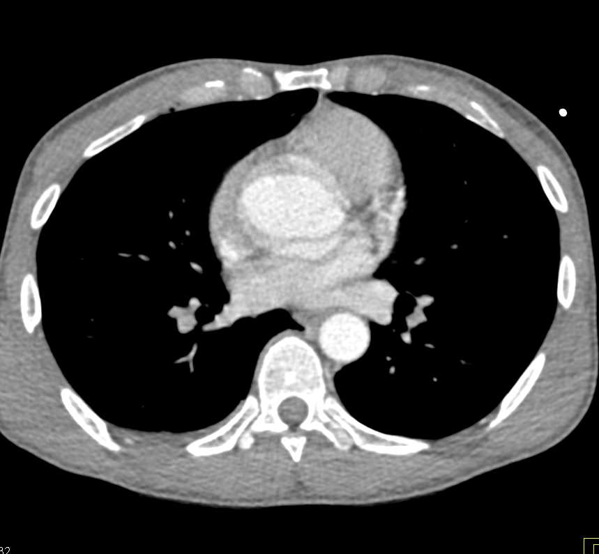 Thymoma - CTisus CT Scan