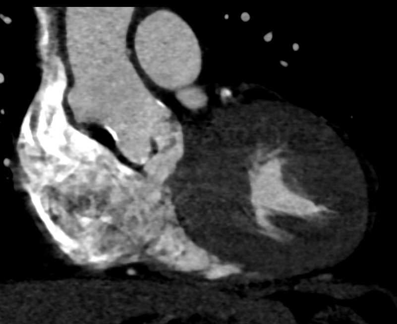 Pseudoaneurysm from Aortic Root - CTisus CT Scan