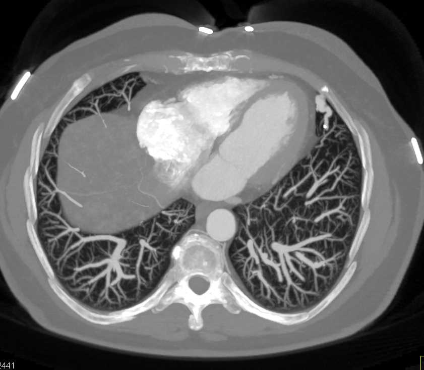 Pulmonary Arteriovenous Malformation (PAVM) Lingula - CTisus CT Scan