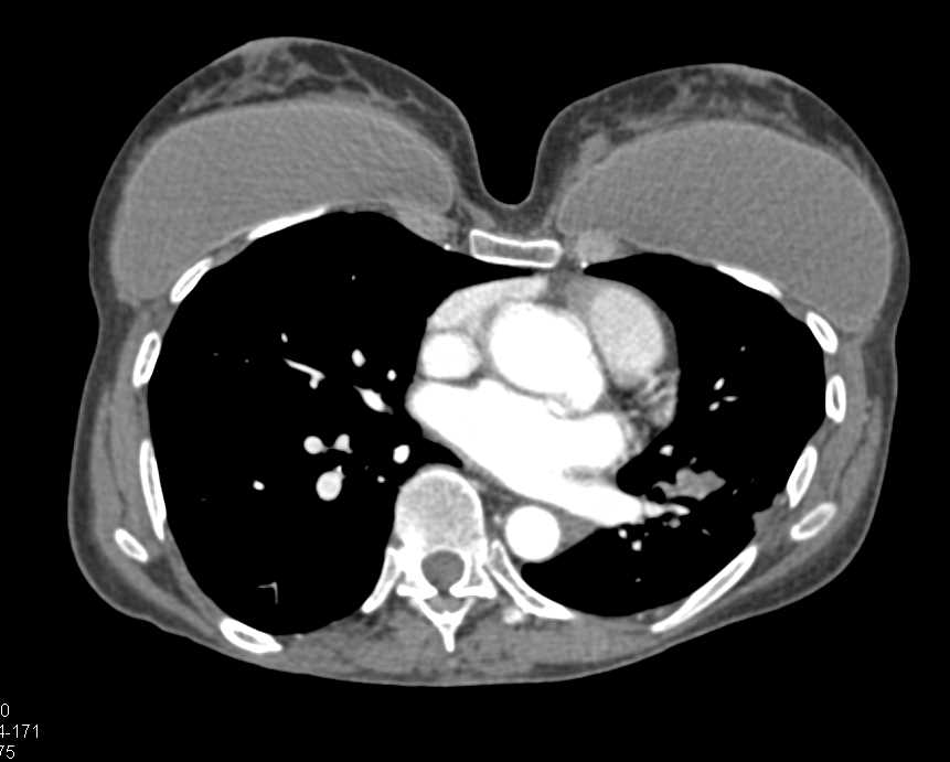 Left Sided Pulmonary Embolism - CTisus CT Scan