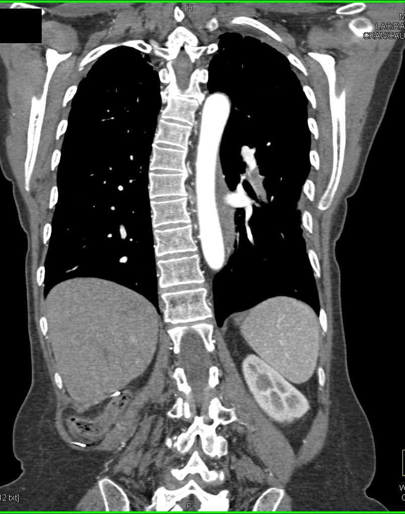 Left Sided Pulmonary Embolism - CTisus CT Scan
