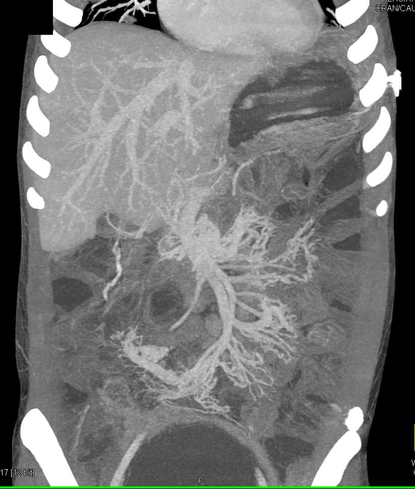 Patchy Infiltrates and Vasculitis - CTisus CT Scan