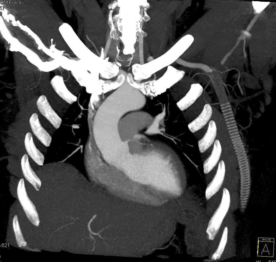 Occluded Graft from Axillary Artery - CTisus CT Scan