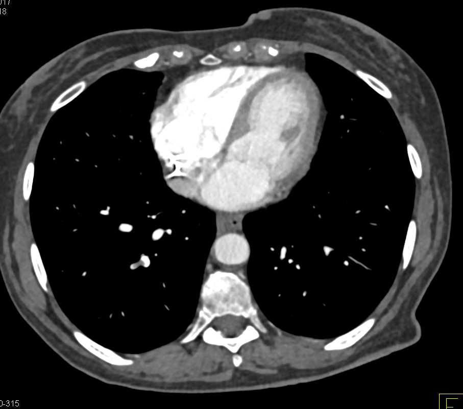 Pulmonary Embolism Right Lower Lung - CTisus CT Scan