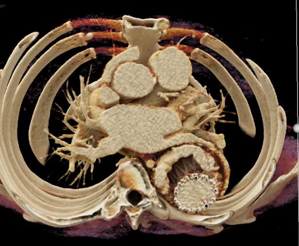 Endovascular Stent with Endoleak - CTisus CT Scan