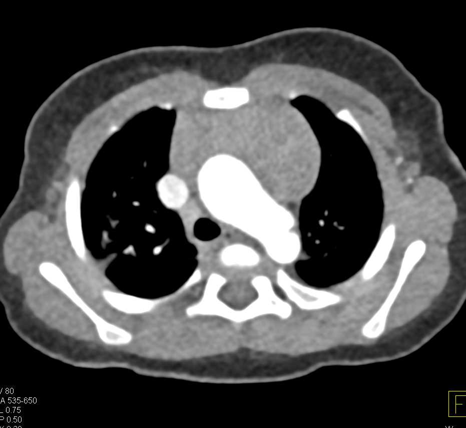 Thymic Hyperplasia - CTisus CT Scan