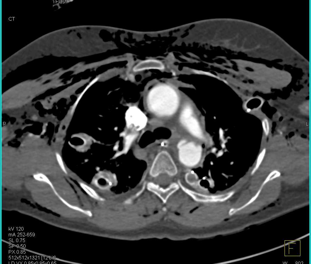 Aortic Pseudoaneurysm s/p Motor Vehicle Accident (MVA) - CTisus CT Scan