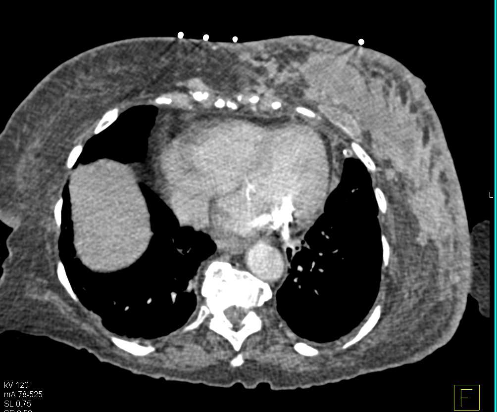 Infiltrating Left Breast Cancer - CTisus CT Scan