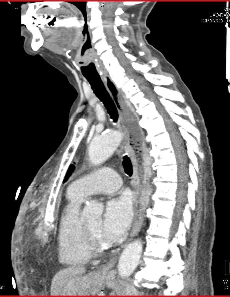 Infiltrating Left Breast Cancer with Axillary Adenopathy - CTisus CT Scan