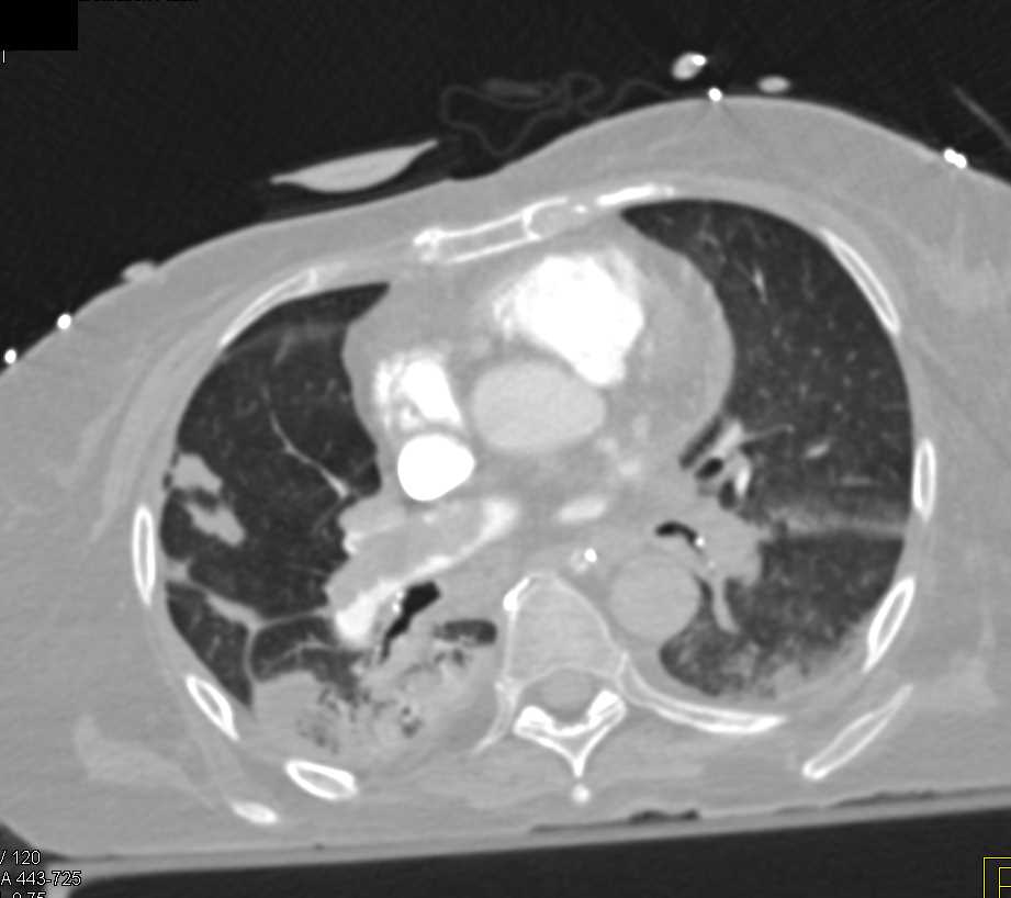 Saddle Pulmonary Embolism (PE) with Infarction - CTisus CT Scan