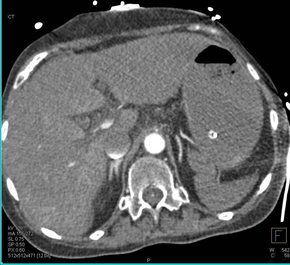 Saddle Pulmonary Embolism (PE) with Bright Adrenals due to Hypoperfusion - CTisus CT Scan