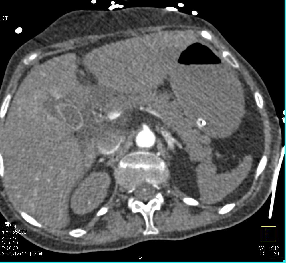 Saddle Pulmonary Embolism (PE) with Bright Adrenals due to Hypoperfusion - CTisus CT Scan