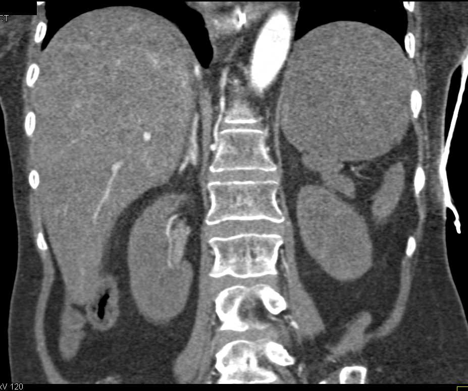Saddle PE with Bright Adrenals due to Hypoperfusion - CTisus CT Scan