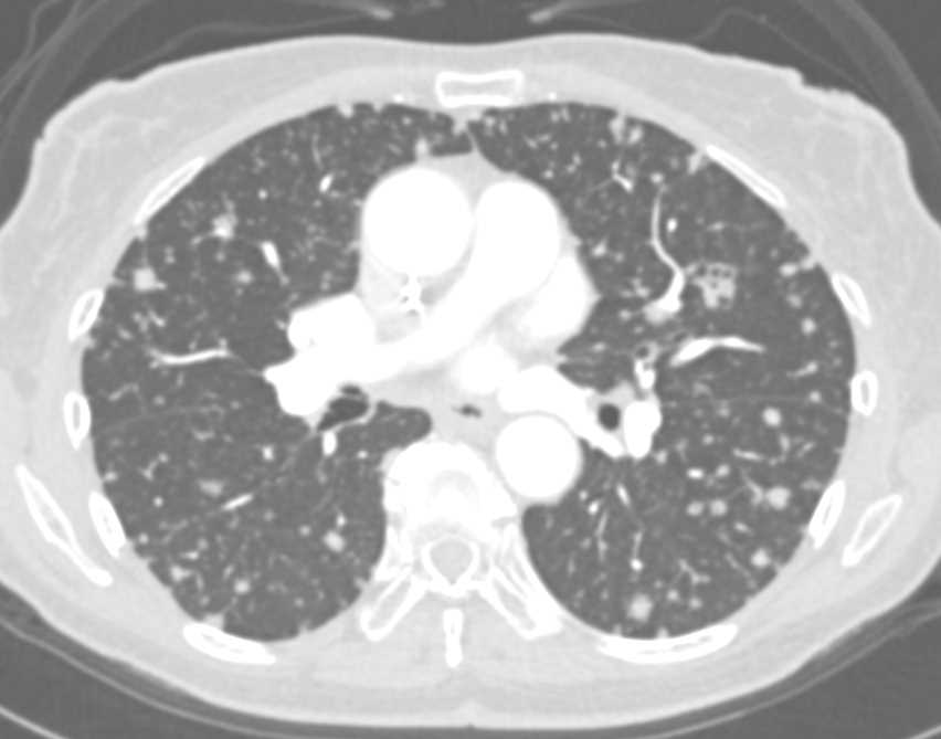 Miliary TB - CTisus CT Scan
