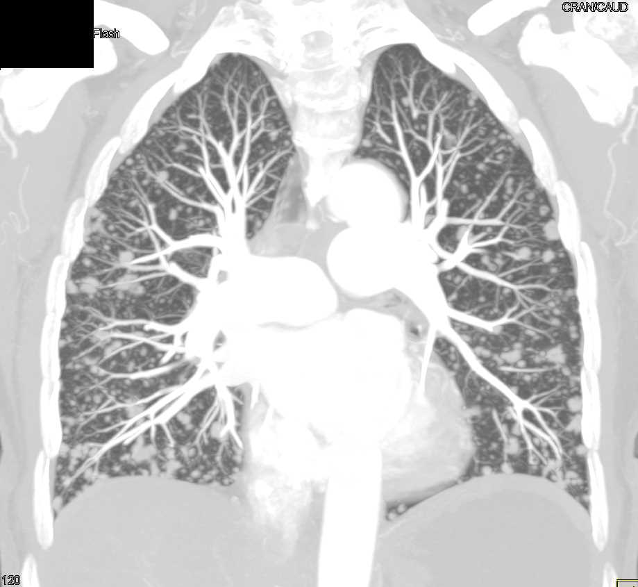 Miliary Tuberculosis (TB) - CTisus CT Scan