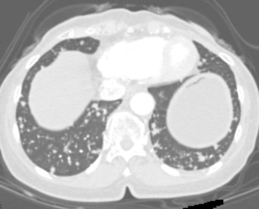Miliary TB - CTisus CT Scan